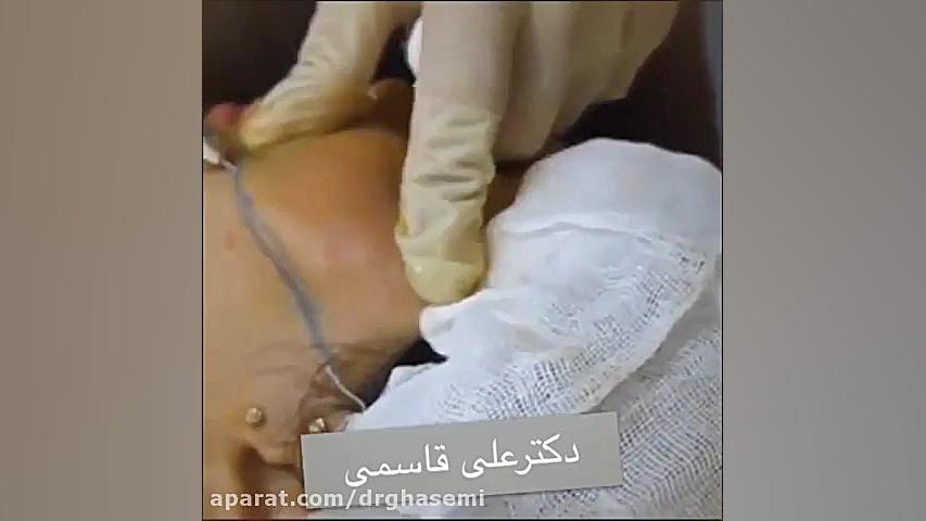 فیلم تزريق چربى به صورت جهت حجم دهى و فرم دهى فرم گونه دکتر علی قاسمی(پوست ، مو ، زیبایی )