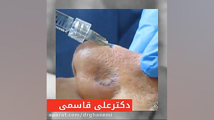 فیلم ❌تزريق فيلر به بينى❌ بدون نياز به جراحى و بيهوشى دکتر علی قاسمی(پوست ، مو ، زیبایی )