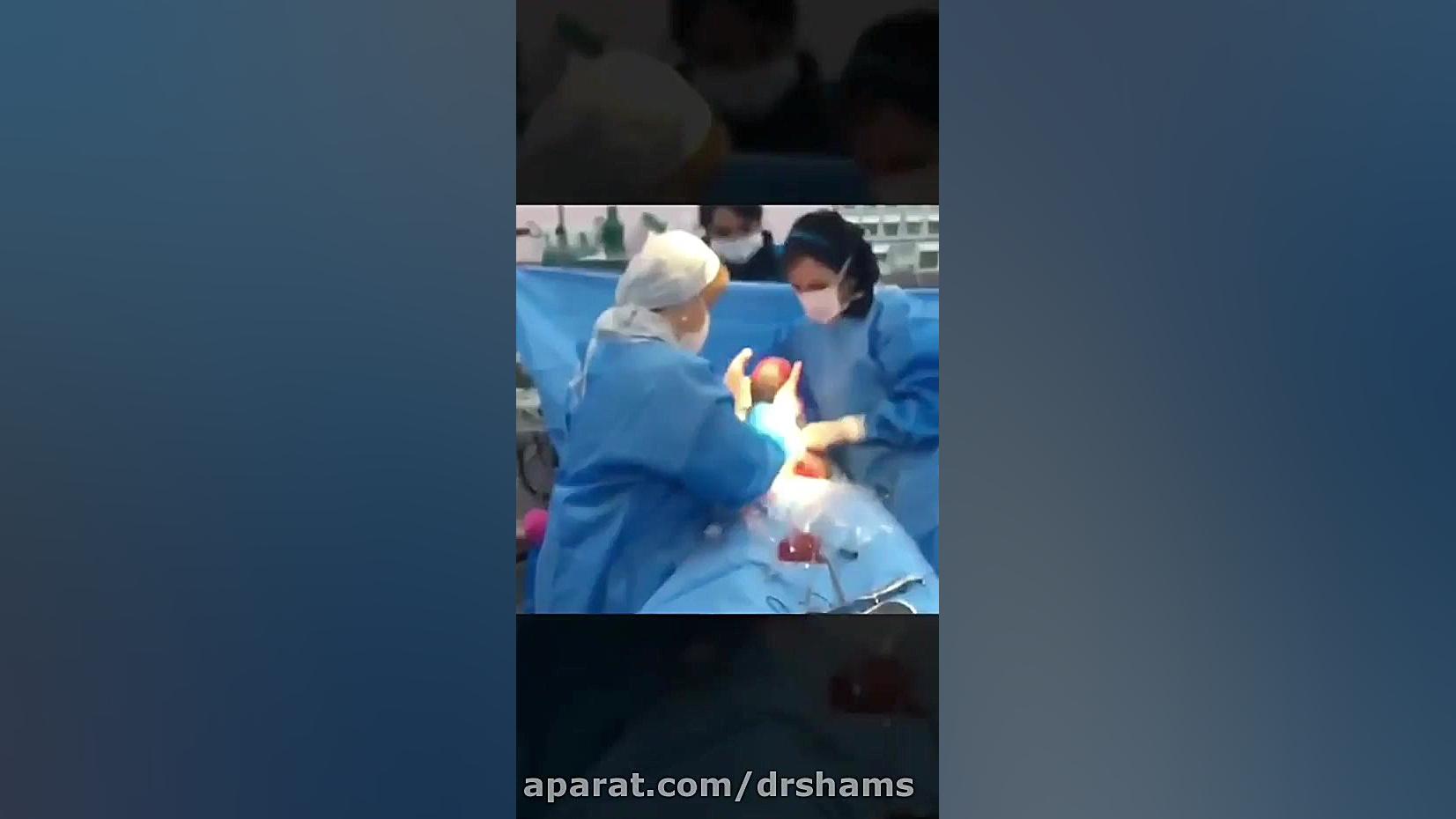سزارین همراه با لیفت شکم دکتر شیرین شمس جراح و متخصص زنان و زایمان