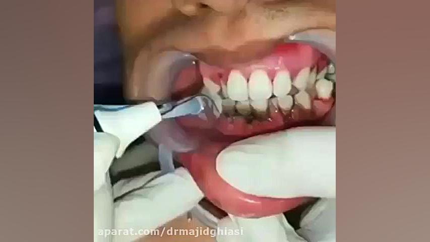 جرمگیری دندان -دکترمجیدقیاسی جراح و دندانپزشک دکترمجیدقیاسی