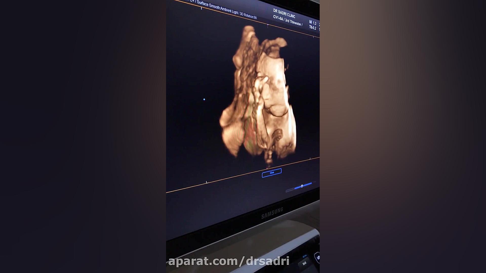 سونوگرافی سه بعدی و چهاربعدی | سونوگرافی دکتر صدری لیفت صورت