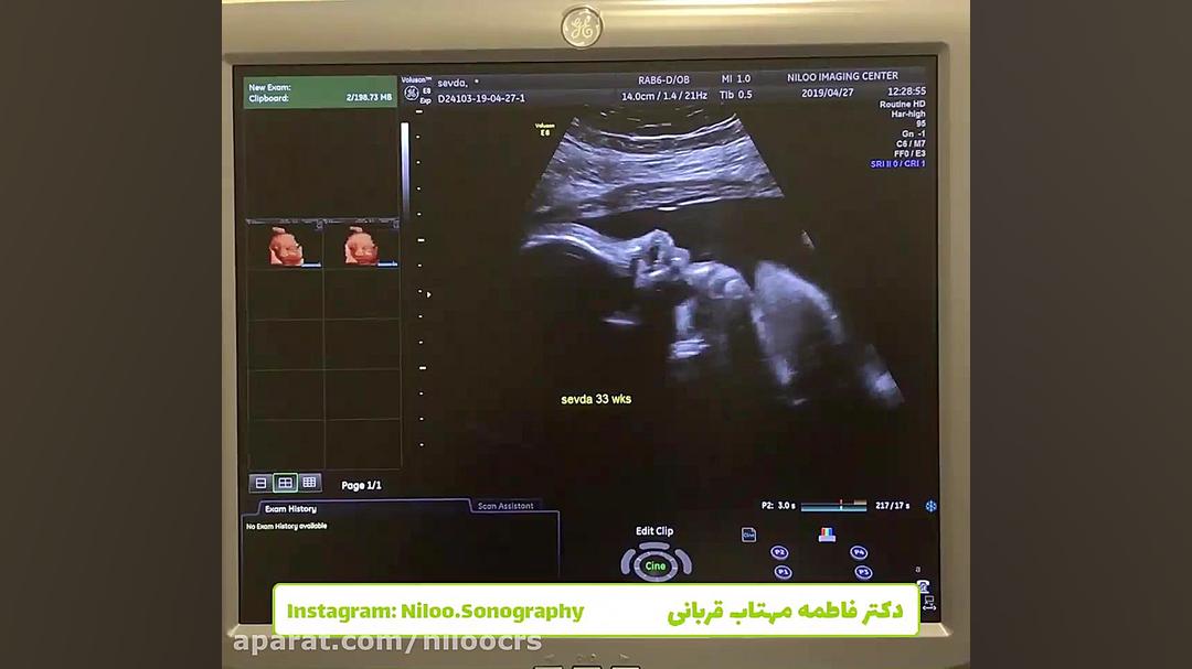 خوشمزه ترین خوردنی داخل رحم مادر سونوگرافی نیلو دکتر فاطمه مهتاب قربانی