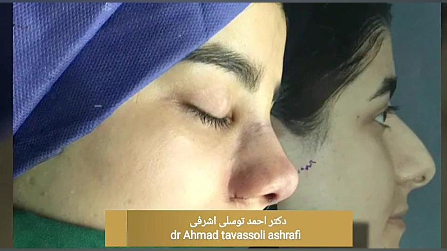 جراح بینی جراحی بینی دکتر احمد توسلی اشرفی