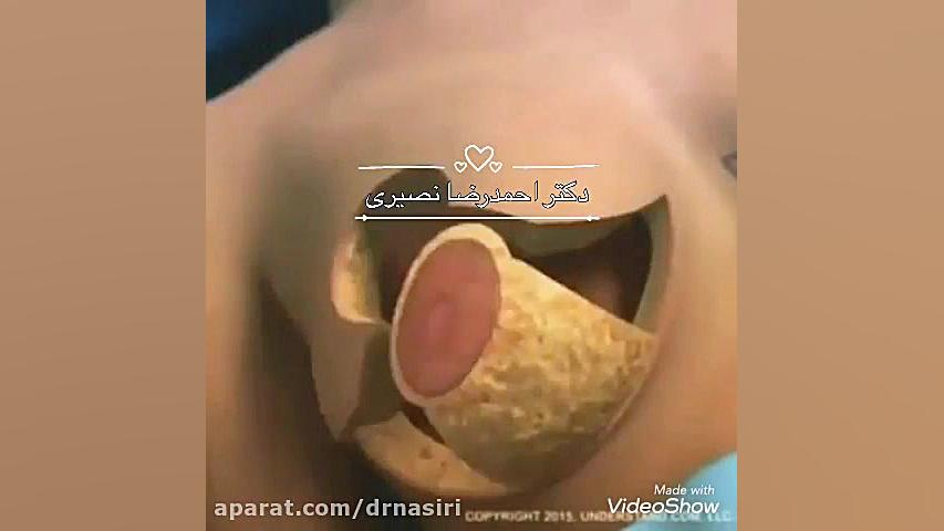 انیمیشن جراحی لیفت سینه دکتر احمدرضا نصیری