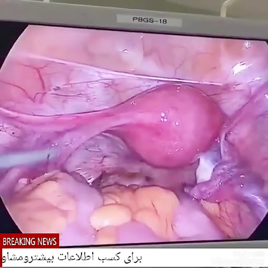 خانومی که سرطانش درمان شد