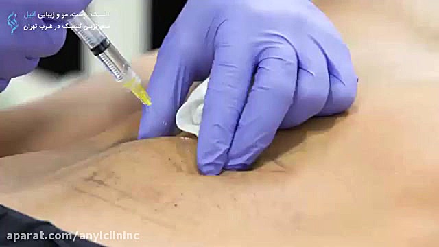 مزوتراپی لاغری بیماری اپیدرمولیز بولوزا