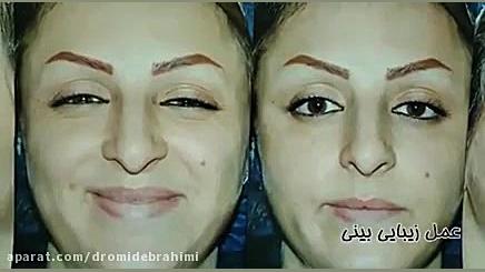 عمل بینی استخوانی توسط دکتر امید ابراهیمی بهترین جراح بینی استخوانی دکتر امید ابراهیمی