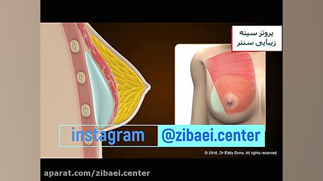 جراحی پروتز سینه - عمل پروتز سینه یا برجسته کردن سینه - زیبایی سنتر ایمپلنت مغز-ماشین