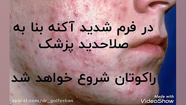 جوش صورت و درمان آن دکتر عاطفه گلفشان، متخصص پوست مو و لیزر درمانی