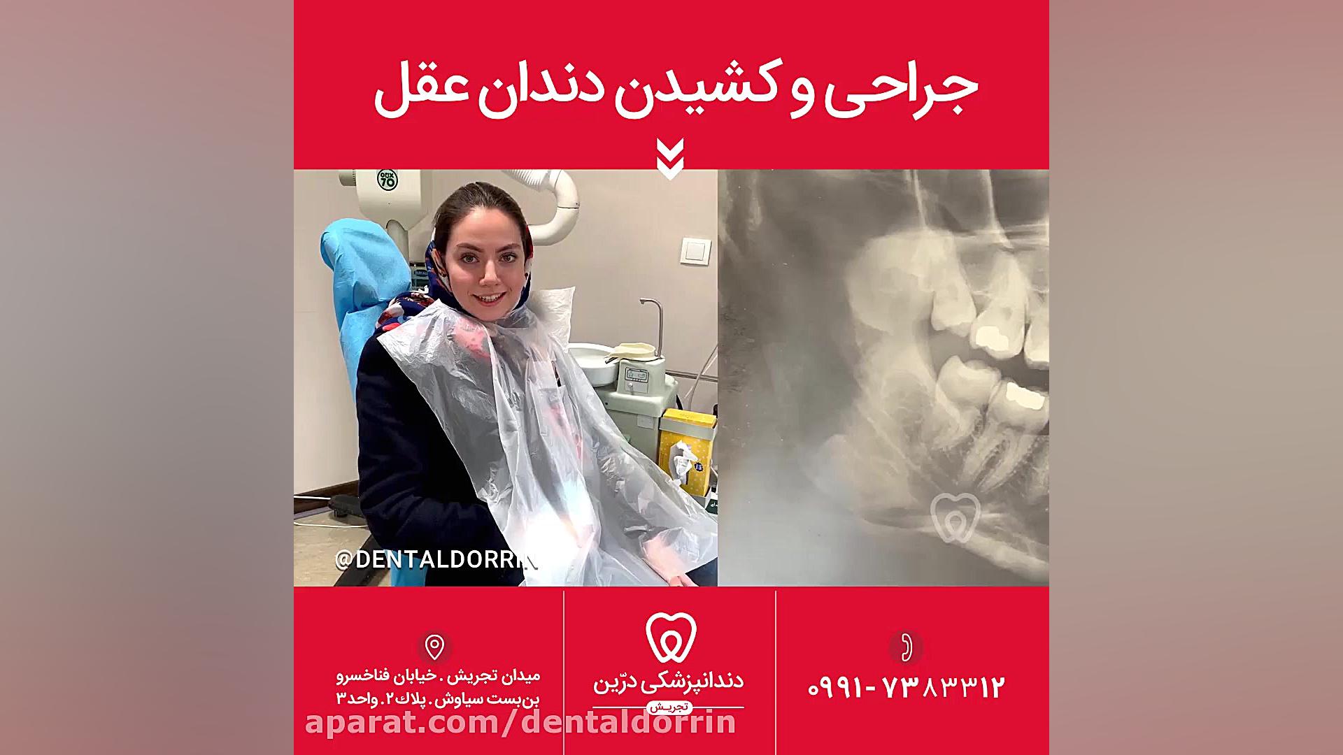 جراحی یا کشیدن دندان گلوسودینیا