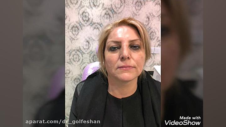 لیزر سی اوتو فرکشنال برای جوانسازی صورت توسط دکتر گلفشان دکتر عاطفه گلفشان، متخصص پوست مو و لیزر درمانی