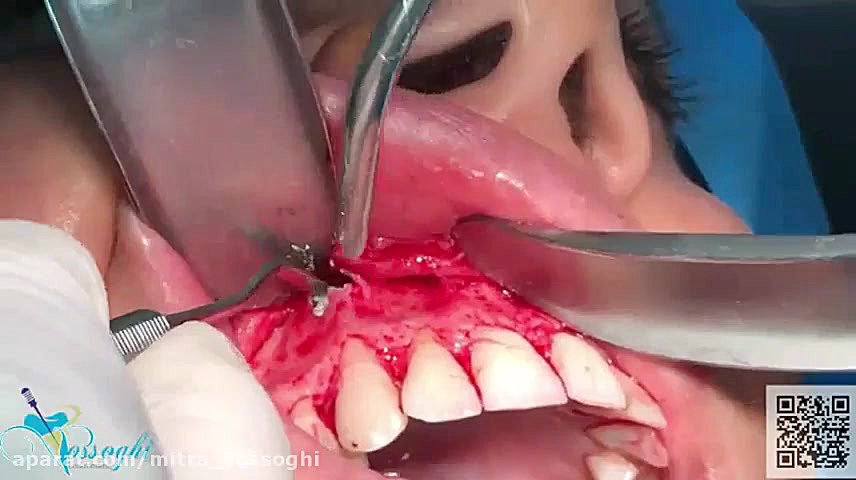 جراحی کیست و ضایعه انتهای ریشه دندان توسط دکتر میترا وثوقی دکتر میترا وثوقی