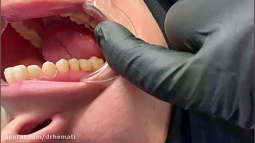 نحوه نخ کشیدن ایمپلنت کانال دکتر مهران همتی. دندانپزشک