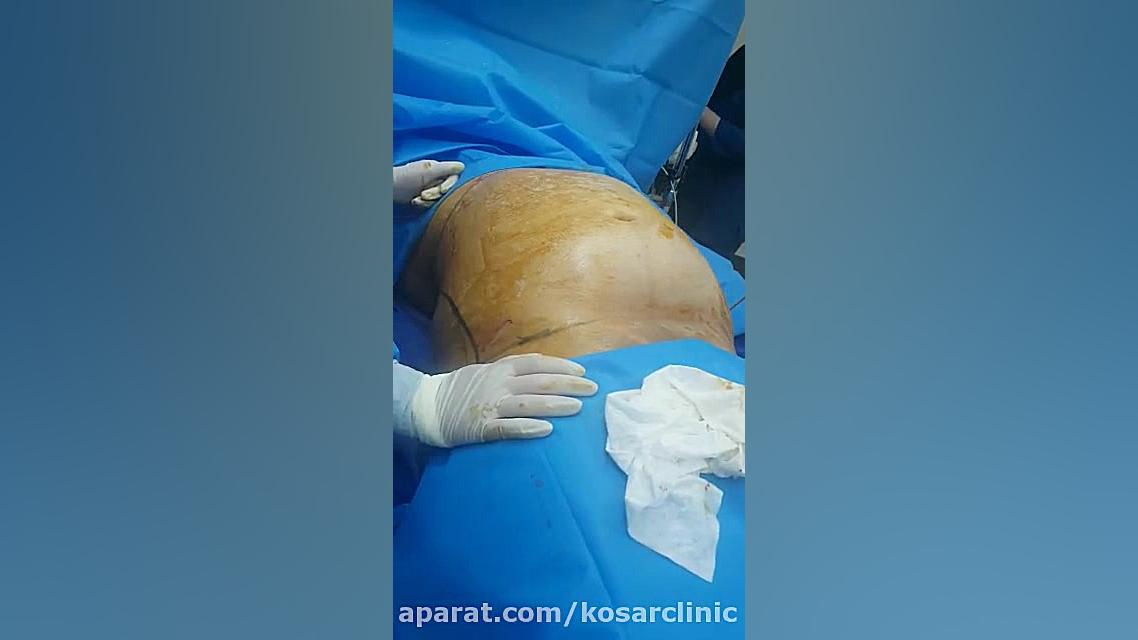 فیلم عمل لیپوماتیک هالوسیناتوری بویایی