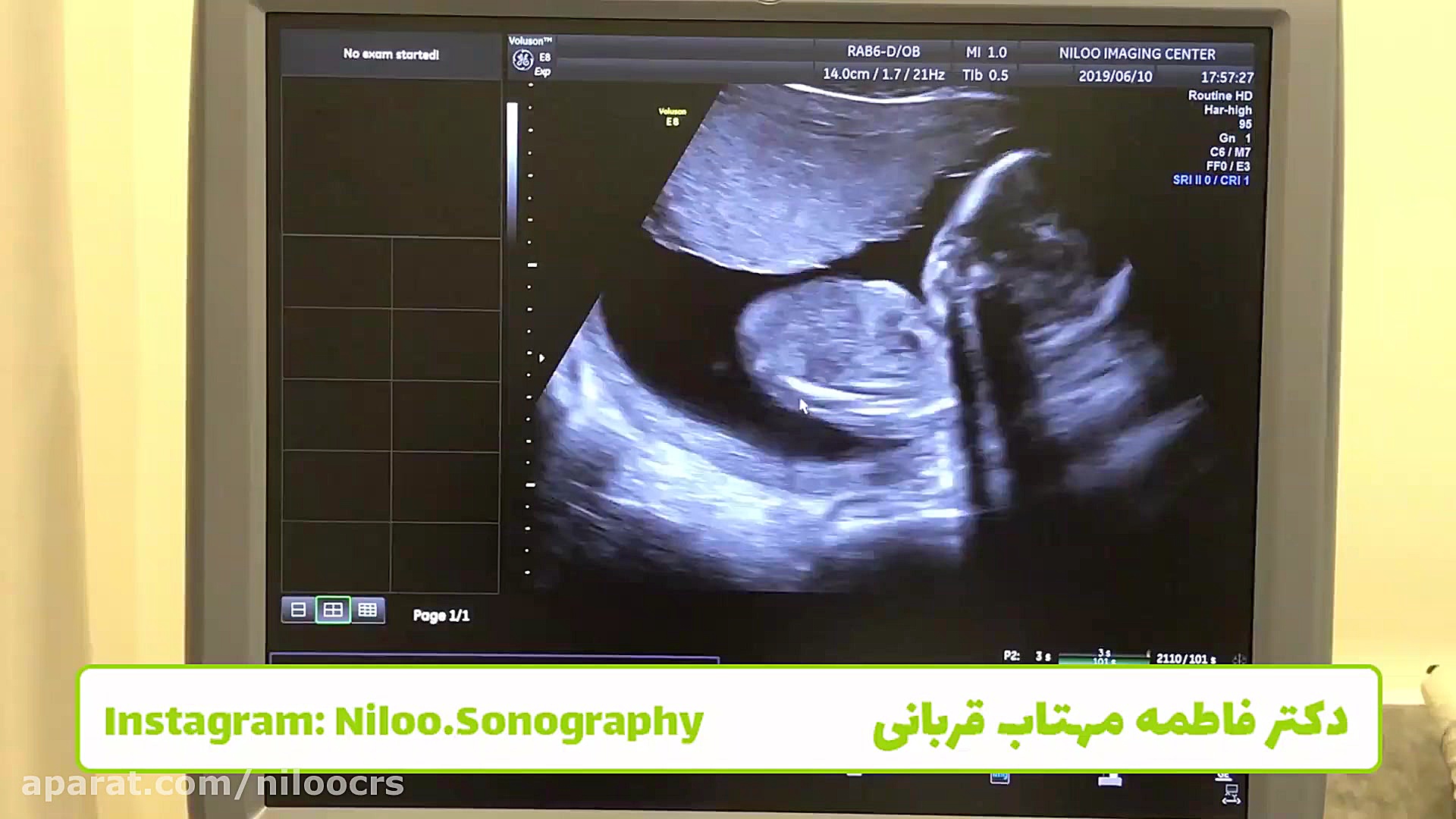اتساع بطن مغز - سونوگرافی بارداری سونوگرافی نیلو دکتر فاطمه مهتاب قربانی