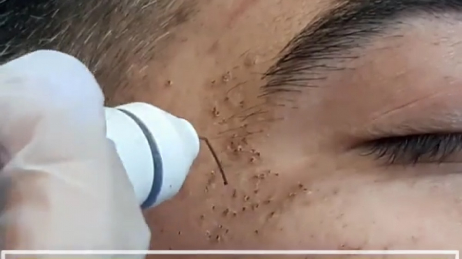 رفع لک صورت , رفع جای جوش درمان اسکار اصلاح فرم صورت
