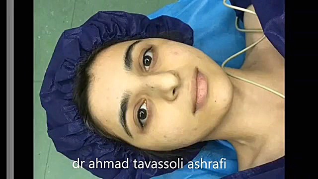 جراحی زیبایی بینی جراحی بینی دکتر احمد توسلی اشرفی