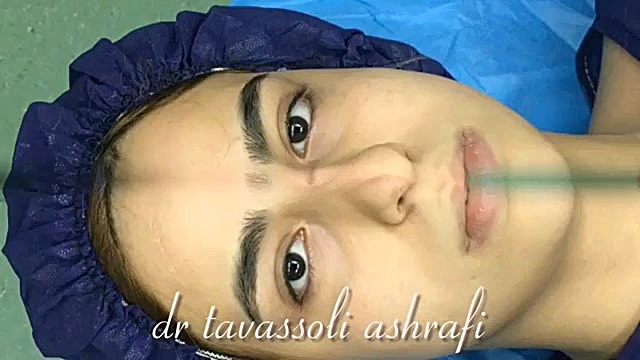 جراحی زیبایی بینی جراحی بینی دکتر احمد توسلی اشرفی
