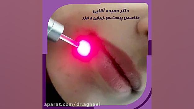فیلم برداشتن خال با لیزر بیماری آسپارتیل گلوکوزامینوریا