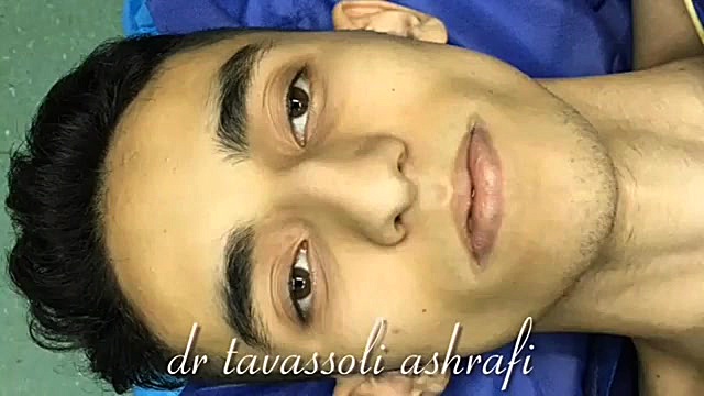 جراحی زیبایی بینی جراحی بینی دکتر احمد توسلی اشرفی
