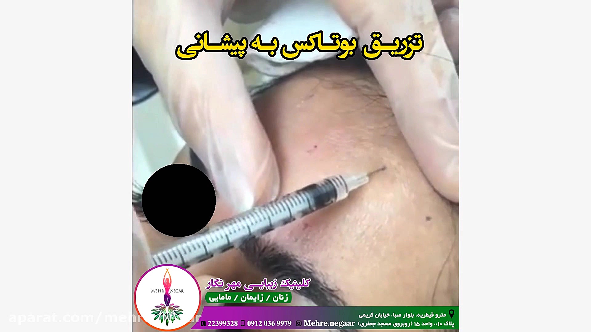 تزریق بوتاکس به پیشانی کاشت ابرو