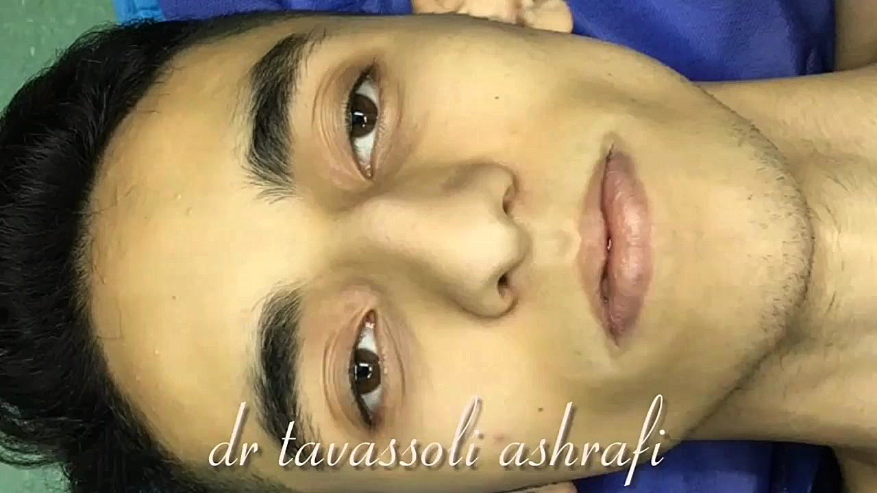 جراحی زیبایی بینی جراحی بینی دکتر احمد توسلی اشرفی