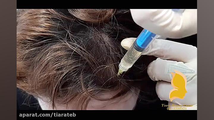 مزوتراپی سر درمان ریزش موها HIDA Scan