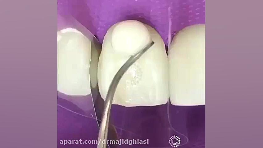 لمینت دندان-دکترمجیدقیاسی دندانپزشک زیبایی مشهد ایمونولوژی محاسباتی