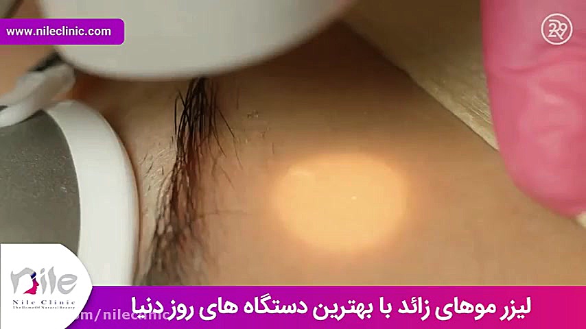 لیزر موهای زائد | فیلم لیزر موهای زائد | کلینیک پوست و مو نیل | شماره 11 تست مهار دگزامتازون