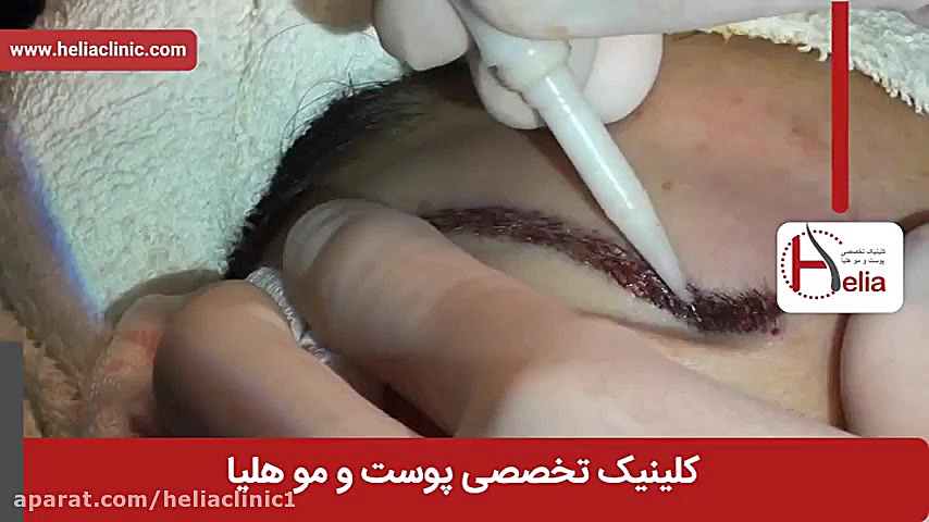 فیلم کاشت ابرو | کلینیک پوست و مو هلیا | شماره 13 | 02179547 PRO-Seq