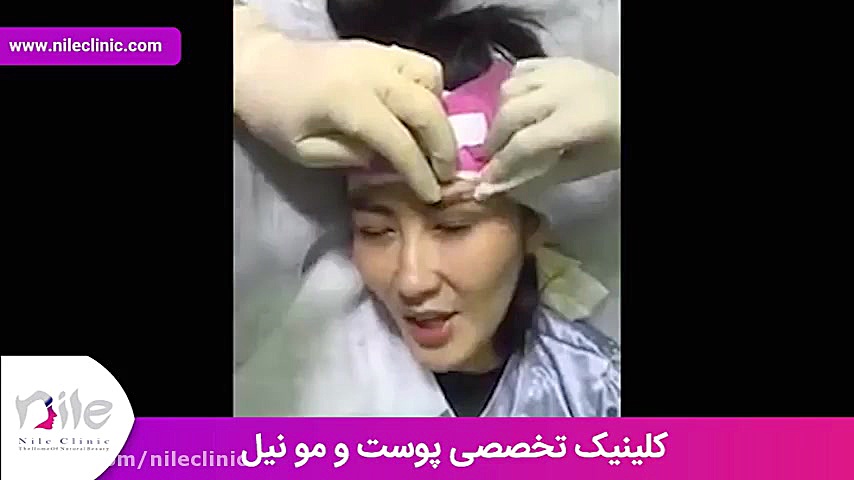 کاشت ابرو | فیلم کاشت ابرو | کلینیک پوست و مو نیل | شماره 15 هیدروراکس
