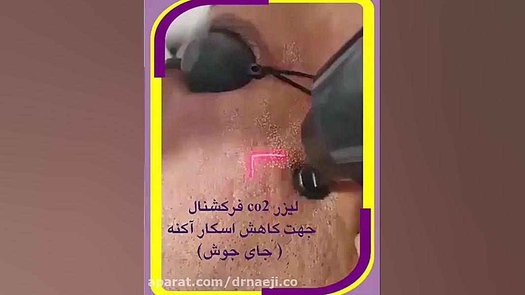 از بین بردن جای جوش و اسکار با لیزر فرکشنال دکتر صدیقه نائیجی | متخصص پوست و مو در قم