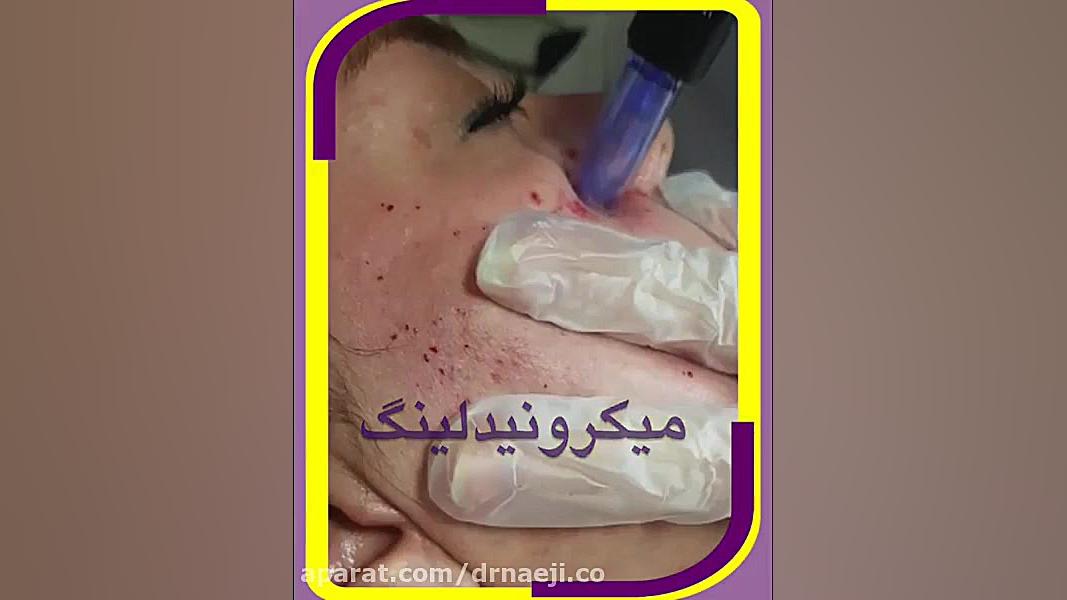 میکرونیدلینگ صورت دکتر صدیقه نائیجی | متخصص پوست و مو در قم