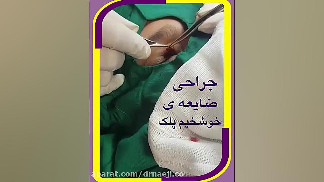 جراحی پلک دکتر صدیقه نائیجی | متخصص پوست و مو در قم