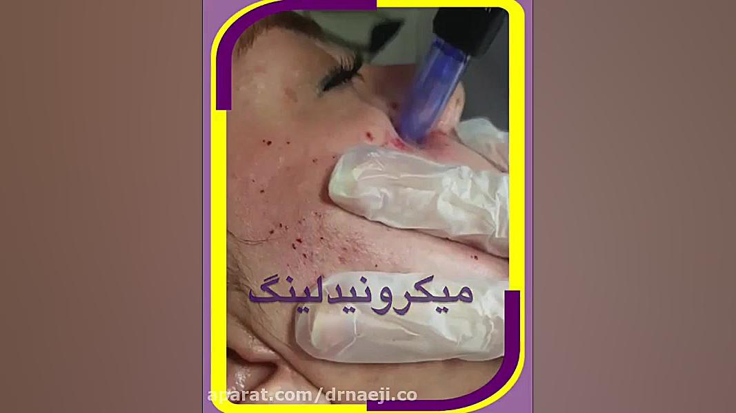 میکرونیدلینگ صورت دکتر صدیقه نائیجی | متخصص پوست و مو در قم