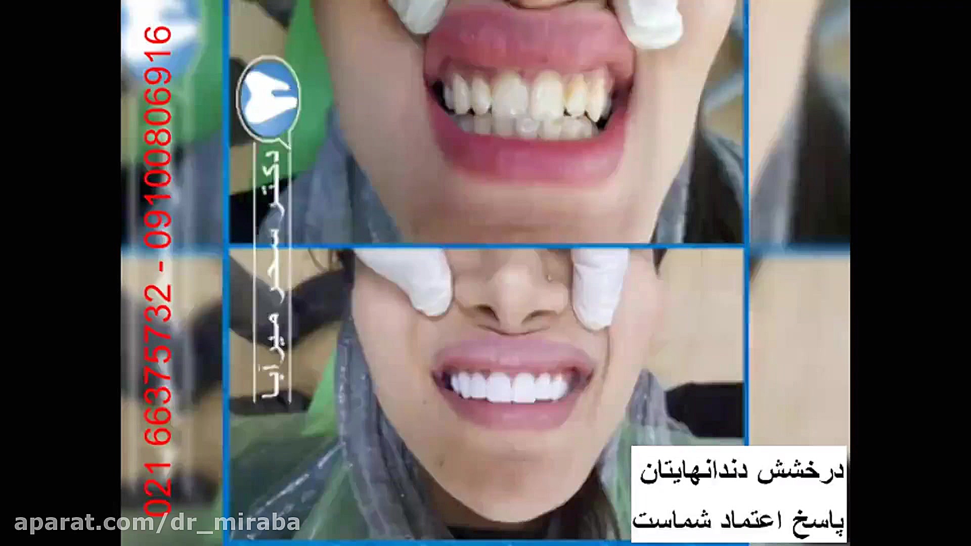 نمونه کار های دکتر سحر میرآبا: اصلاح طرح لبخند، فرم زیبای دندان ها بیومهندسی عصبی