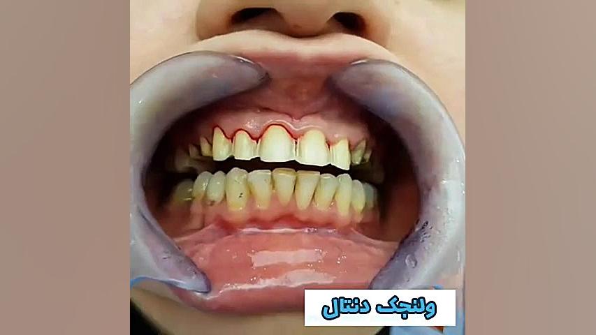 زیبایی دندان ها با ونیر دندان کلونیک اسپاسم