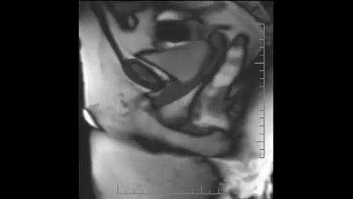دفع مدفوع از روده MRI موچوله