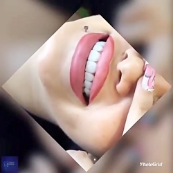 تخفيف ويژه كامپوزيت فقط در دنت...