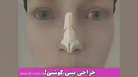 جراحی بینی گوشتی دکتر اسماعیل فرزاد فرد - فوق تخصص پلاستیک