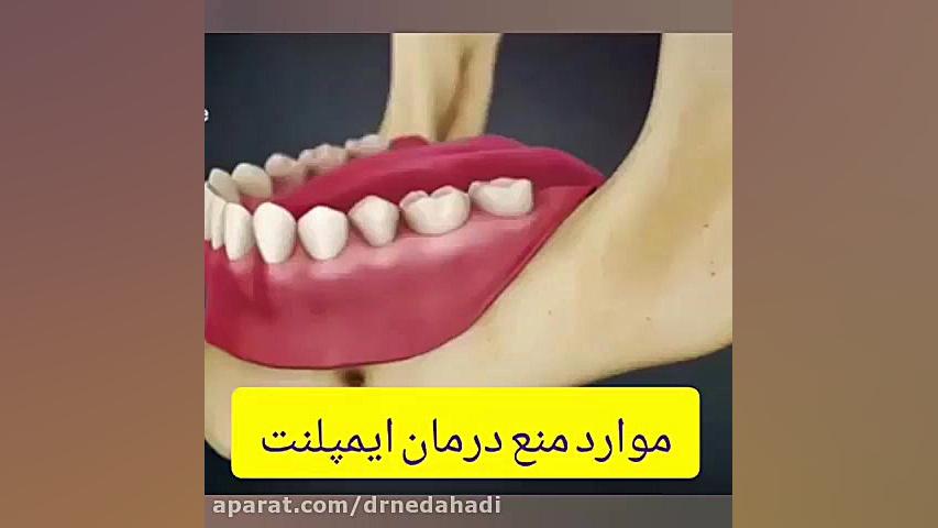 این افراد نباید ایمپلنت کنند!!! دکتر ندا هادی-دندانپزشک زیبایی