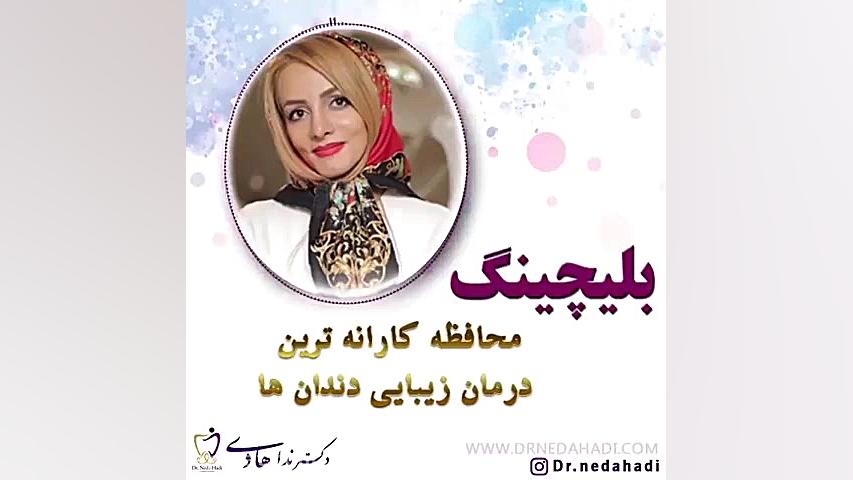 درمان زیبایی ایمن با بلیچینگ دندان دکتر ندا هادی-دندانپزشک زیبایی