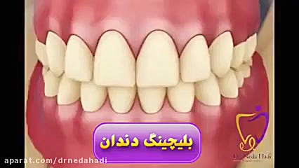 فیلم بلیچینگ دندان دکتر ندا هادی-دندانپزشک زیبایی