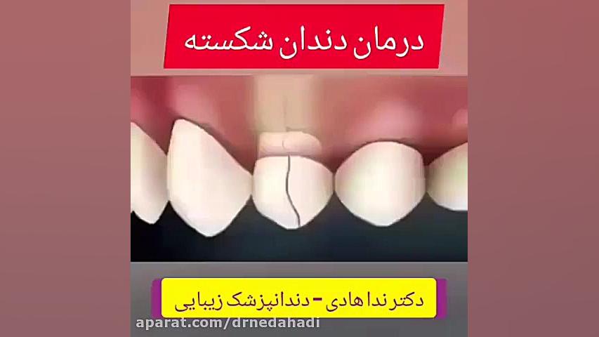 درمان دندان شکسته با روکش های زیبایی دکتر ندا هادی-دندانپزشک زیبایی