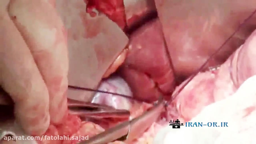 آموزش جراحی کیسه صفرا با دوبله فارسی