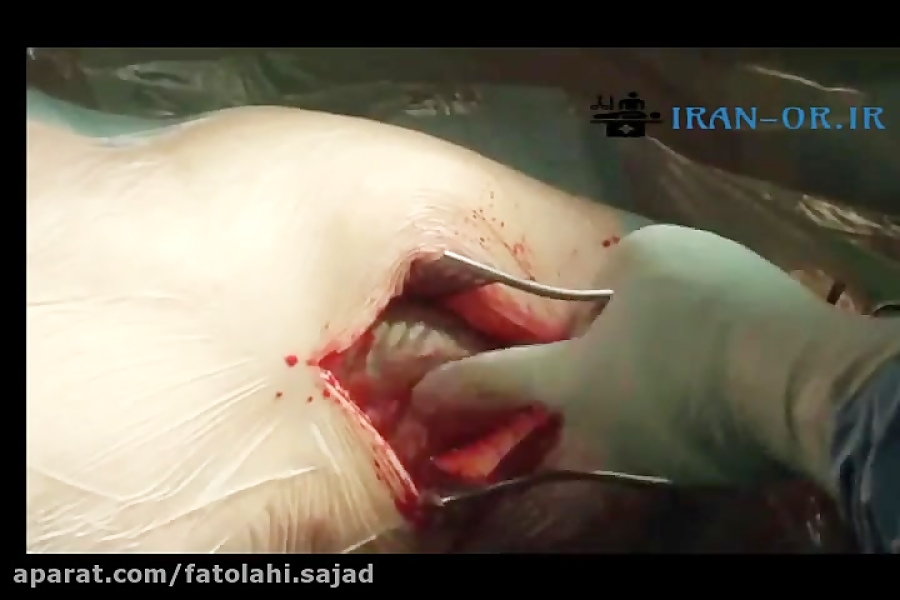 آموزش جراحی شکستگی اینترتروک با پلاک DHS با دوبله فارسی