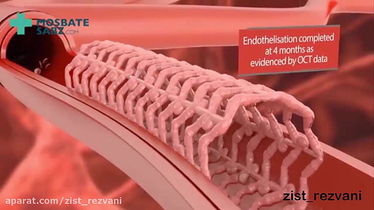 آنژیوگرافی/آنژیوپلاستی و استنت گذاری در رگهای کرونری قلب/جراحی قلب/خون/سکته قلبی اکستنشن تاج دندان