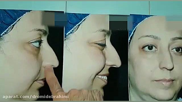 جراحی انحراف بینی توسط دکتر امید ابراهیمی بهترین جراح بینی دکتر امید ابراهیمی