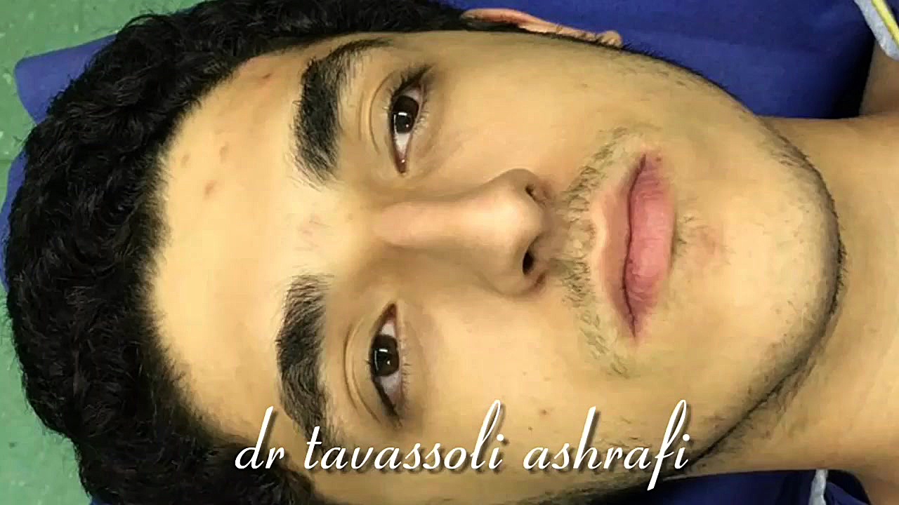 جراحی زیبایی بینی به روش بسته (بدون برش و بدون بخیه) جراحی بینی دکتر احمد توسلی اشرفی