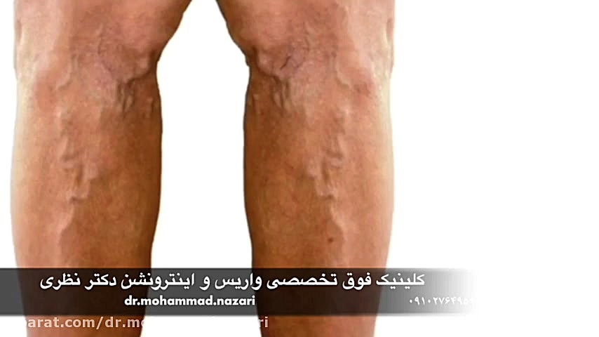 واریس چیست؟ دکتر محمد نظری-فوق تخصص اینترونشنال رادیولوژی